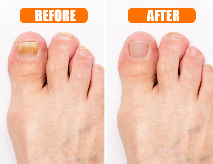 Hewelth BioClear Nails - benefits